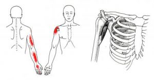 Coracobrachialis spoušťový bod