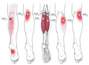 Gastrocnemius spoušťový bod
