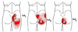 Gluteus maximus spoušťový bod