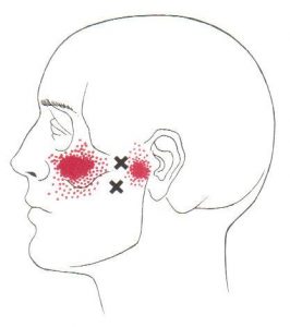 Pterygoideus lateralis spoušťový bod