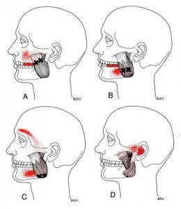 Masseter spoušťový bod