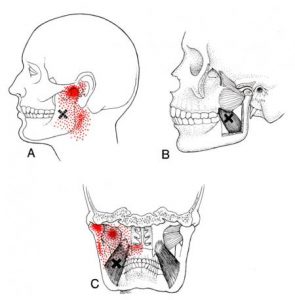 Pterygoideus medialis spoušťový bod