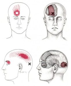 Frontalis a occipitalis spoušťový bod
